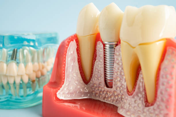 Best Root Canal Treatment  in Miramar, FL